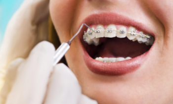 5 Myths About Mouth &amp; Teeth Whitening